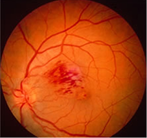 Eye with Branch Retinal Vein Occlusion