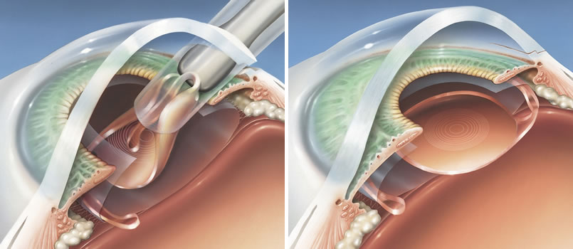 Phacoemulsification