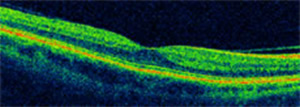 Scan of Normal Retina