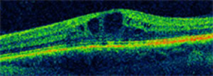 Scan of Retina with Oedema