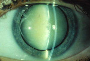 White Cataract